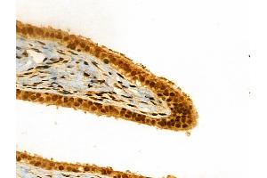 ABIN6261157 and ABIN6266615 at 1/100 staining Human ovarian cancer and adjacent normal tissues by IHC-P.