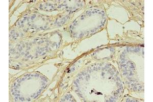 Immunohistochemistry of paraffin-embedded human breast cancer using ABIN7168555 at dilution of 1:100 (SKP2 抗体  (AA 1-424))