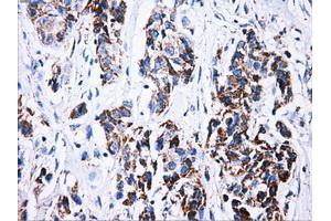 Immunohistochemical staining of paraffin-embedded Carcinoma of liver tissue using anti-ATP5Bmouse monoclonal antibody. (ATP5B 抗体)