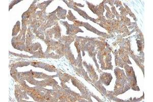 Formalin-fixed, paraffin-embedded human ovarian carcinoma stained with GnRH Receptor antibody (F1G4)