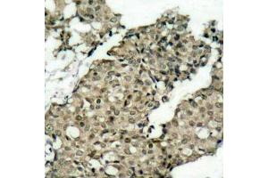 Immunohistochemistry of paraffin-embedded human breast carcinoma using Phospho-G3BP1-S232 antibody (ABIN2988019).