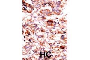 Formalin-fixed and paraffin-embedded human cancer tissue reacted with the primary antibody, which was peroxidase-conjugated to the secondary antibody, followed by AEC staining. (ADCK5 抗体  (C-Term))