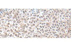Immunohistochemistry of paraffin-embedded Human ovarian cancer tissue using UBN1 Polyclonal Antibody at dilution of 1:130(x200) (Ubinuclein 1 抗体)