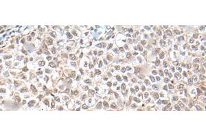 Immunohistochemistry of paraffin-embedded Human ovarian cancer tissue using UBN1 Polyclonal Antibody at dilution of 1:130(x200) (Ubinuclein 1 抗体)