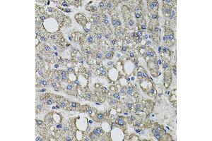 Immunohistochemistry of paraffin-embedded human liver injury using GFPT1 antibody at dilution of 1:100 (x40 lens). (GFPT1 抗体)