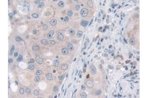 Detection of NID2 in Human Breast cancer Tissue using Polyclonal Antibody to Nidogen 2 (NID2) (NID2 抗体  (AA 31-289))