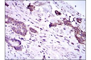 Immunohistochemical analysis of paraffin-embedded esophageal cancer tissues using DNAL4 mouse mAb with DAB staining. (DNAL4 抗体  (AA 1-105))