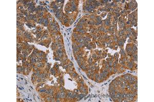 Immunohistochemistry of Human cervical cancer using ADAMTS15 Polyclonal Antibody at dilution of 1:60 (ADAMTS15 抗体)