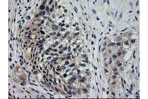 Immunohistochemical staining of paraffin-embedded Carcinoma of Human bladder tissue using anti-XPNPEP3 mouse monoclonal antibody. (XPNPEP3 抗体)