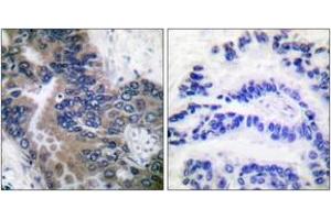 Immunohistochemistry analysis of paraffin-embedded human lung carcinoma tissue, using APAF-1-ALT Antibody. (APAF1 抗体  (AA 289-338))
