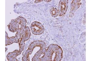 IHC-P Image ACADM antibody detects ACADM protein at mitochondria on human colon carcinoma by immunohistochemical analysis. (Medium-Chain Specific Acyl-CoA Dehydrogenase, Mitochondrial (MCAD) (Center) 抗体)