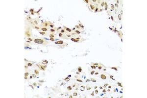 Immunohistochemistry of paraffin-embedded human lung cancer using RAB3IP antibody at dilution of 1:100 (x40 lens). (RAB3IP 抗体)