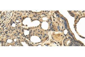 Immunohistochemistry of paraffin-embedded Human thyroid cancer tissue using TRPC4AP Polyclonal Antibody at dilution 1:40 (TRPC4AP 抗体)