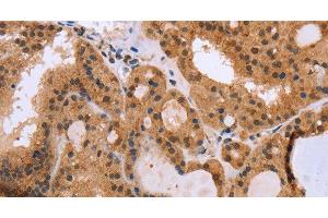 Immunohistochemistry of paraffin-embedded Human thyroid cancer using EPDR1 Polyclonal Antibody at dilution of 1:40 (EPDR1 抗体)
