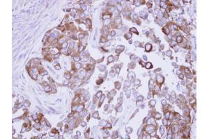 IHC-P Image Immunohistochemical analysis of paraffin-embedded OECM1 xenograft, using Fatty Acid Synthase, antibody at 1:500 dilution. (Fatty Acid Synthase 抗体  (N-Term))