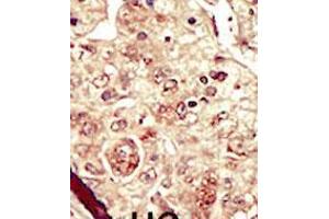 Formalin-fixed and paraffin-embedded human cancer tissue reacted with the primary antibody, which was peroxidase-conjugated to the secondary antibody, followed by DAB staining. (STK16 抗体  (C-Term))