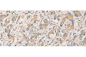 Immunohistochemistry of paraffin-embedded Human liver cancer tissue using GNAZ Polyclonal Antibody at dilution of 1:70(x200) (GNaZ 抗体)