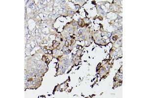 Immunohistochemistry of paraffin-embedded human lung cancer using Mucin 5AC (MUC5AC) antibody (ABIN7268694) at dilution of 1:50 (40x lens). (MUC5AC 抗体  (C-Term))