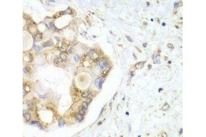 Immunohistochemistry of paraffin-embedded Human liver cancer using VTI1B Polyclonal Antibody at dilution of 1:100 (40x lens).