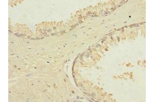 Immunohistochemistry of paraffin-embedded human prostate cancer using ABIN7172867 at dilution of 1:100 (TRPM4 抗体  (AA 1-240))