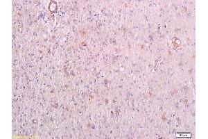 Formalin-fixed and paraffin embedded human endometrial carcinoma labeled with Anti-phospho-PRKCQ(Thr538) Polyclonal Antibody, Unconjugated (ABIN711746) at 1:200 followed by conjugation to the secondary antibody (PKC theta 抗体  (pThr538))
