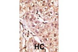 Formalin-fixed and paraffin-embedded human cancer tissue reacted with the primary antibody, which was peroxidase-conjugated to the secondary antibody, followed by DAB staining. (IL29 抗体  (AA 54-85))