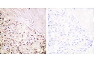Peptide - +Immunohistochemical analysis of paraffin-embedded human breast carcinoma tissue using FANCD2 (Ab-222) antibody (#B0427). (FANCD2 抗体  (Ser222))