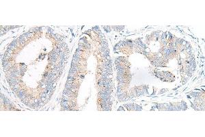 Immunohistochemistry of paraffin-embedded Human colorectal cancer tissue using GARNL3 Polyclonal Antibody at dilution of 1:100(x200) (GARNL3 抗体)