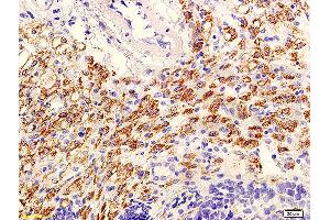 Formalin-fixed and paraffin embedded mouse tumor with labeled Anti-phospho-AKT/PKB(Ser473) Polyclonal Antibody, Unconjugated (ABIN729298) at 1:600, followed by conjugation to the secondary antibody and DAB staining (AKT 1/2/3 抗体  (pSer473))