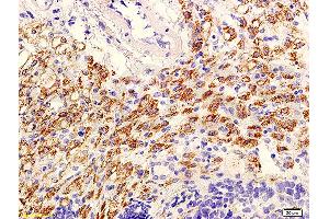 Formalin-fixed and paraffin embedded mouse tumor with labeled Anti-phospho-AKT/PKB(Ser473) Polyclonal Antibody, Unconjugated (ABIN729298) at 1:600, followed by conjugation to the secondary antibody and DAB staining