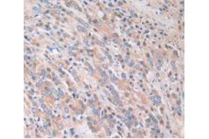 IHC-P analysis of Human Prostate Gland Cancer Tissue, with DAB staining. (Caspase 4 抗体  (AA 944-1148))