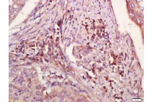 Formalin-fixed and paraffin embedded human laryngocarcinoma labeled with Anti-WDR26 Polyclonal Antibody, Unconjugated (ABIN729988) at 1:200 followed by conjugation to the secondary antibody and DAB staining (WDR26 抗体  (AA 101-200))