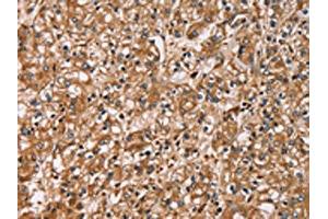 The image on the left is immunohistochemistry of paraffin-embedded Human prostate cancer tissue using ABIN7129785(HTR3C Antibody) at dilution 1/30, on the right is treated with fusion protein. (HTR3C 抗体)