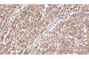ABIN6279444 at 1/100 staining Human Melanoma tissue by IHC-P. (FGF9 抗体  (N-Term))