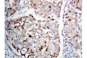 Anti-MEK1 antibody, IHC(P) IHC(P): Human Lung Cancer Tissue (MEK1 抗体  (C-Term))