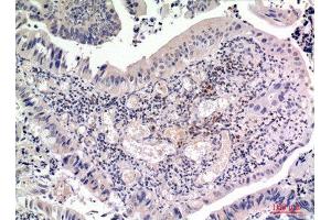 Immunohistochemistry (IHC) analysis of paraffin-embedded Human Colon Cancer, antibody was diluted at 1:100.