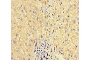 Immunohistochemistry of paraffin-embedded human liver cancer using ABIN7175867 at dilution of 1:100 (WAC 抗体  (AA 10-102))