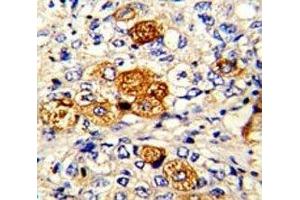 IHC analysis of FFPE human breast carcinoma with C5 antibody (C5 抗体  (AA 253-281))