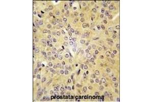 Formalin-fixed and paraffin-embedded human prostata carcinoma tissue reacted with LARS antibody (C-term) (ABIN391611 and ABIN2841532) , which was peroxidase-conjugated to the secondary antibody, followed by DAB staining. (LARS 抗体  (C-Term))