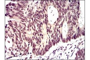 Immunohistochemical analysis of paraffin-embedded rectum cancer tissues using ID2 mouse mAb with DAB staining. (Id2 抗体  (AA 1-134))