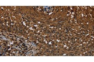 Immunohistochemistry of paraffin-embedded Human cervical cancer tissue using MYBBP1A Polyclonal Antibody at dilution 1:40 (MYBBP1A 抗体)