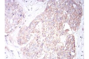 Immunohistochemical analysis of paraffin-embedded ovarian cancer tissues using SK2 mouse mAb with DAB staining. (KCNN2 抗体  (AA 36-52))