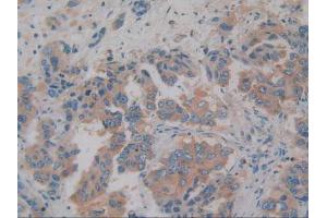 IHC-P analysis of Human Breast Cancer Tissue, with DAB staining. (AZGP1 抗体)