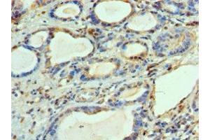 Immunohistochemistry of paraffin-embedded human prostate cancer using ABIN7144450 at dilution of 1:100 (BCL2L14 抗体  (AA 1-327))