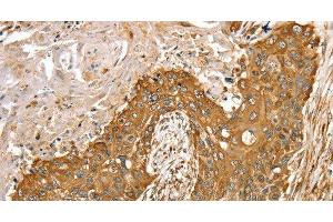 Immunohistochemistry of paraffin-embedded Human esophagus cancer tissue using RASSF9 Polyclonal Antibody at dilution 1:45