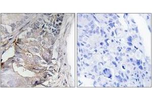 Immunohistochemistry analysis of paraffin-embedded human colon carcinoma, using PDGFR beta (Phospho-Tyr740) Antibody. (PDGFRB 抗体  (pTyr740))