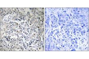 Immunohistochemistry analysis of paraffin-embedded human breast carcinoma, using NF-kappaB p65 (Phospho-Thr505) Antibody. (NF-kB p65 抗体  (pThr505))