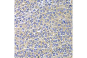 Immunohistochemistry of paraffin-embedded mouse cancer using STAT4 antibody. (STAT4 抗体)