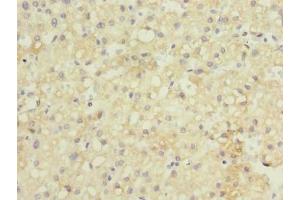 Immunohistochemistry of paraffin-embedded human liver cancer using ABIN7154545 at dilution of 1:100 (GDF2 抗体  (AA 300-429))