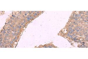Immunohistochemistry of paraffin-embedded Human liver cancer tissue using KCNN3 Polyclonal Antibody at dilution of 1:40(x200) (KCNN3 抗体)